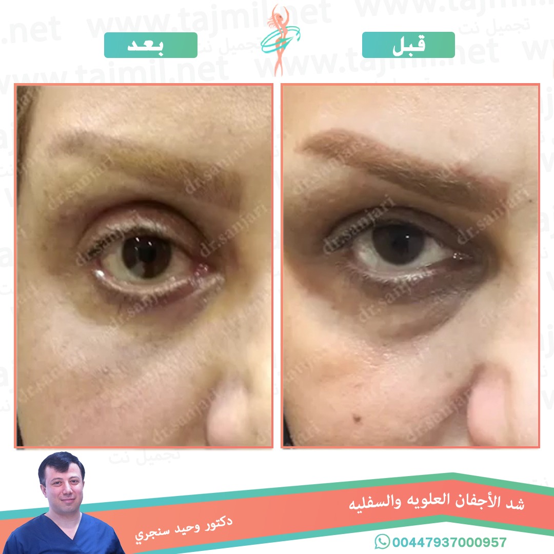  - دکتور وحید سنجري عملية شد الأجفان العویة و السفلیه في ايران مع تجميل نت