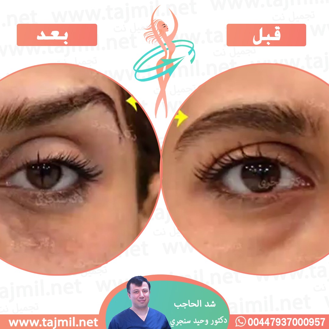  - دکتور وحید سنجري عملية شد الحاجب في ايران مع تجميل نت