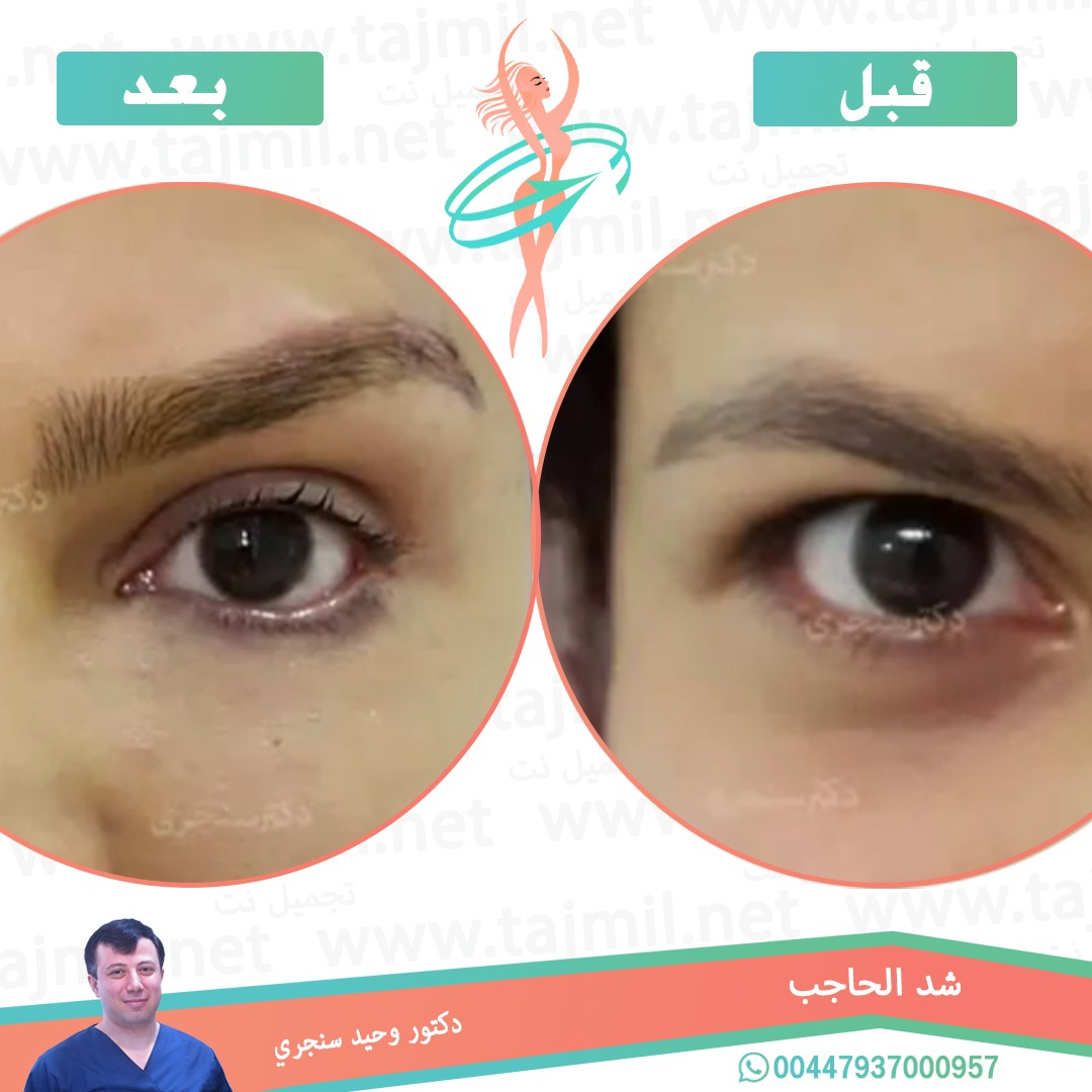  - دکتور وحید سنجري عملية شد الحاجب في ايران مع تجميل نت