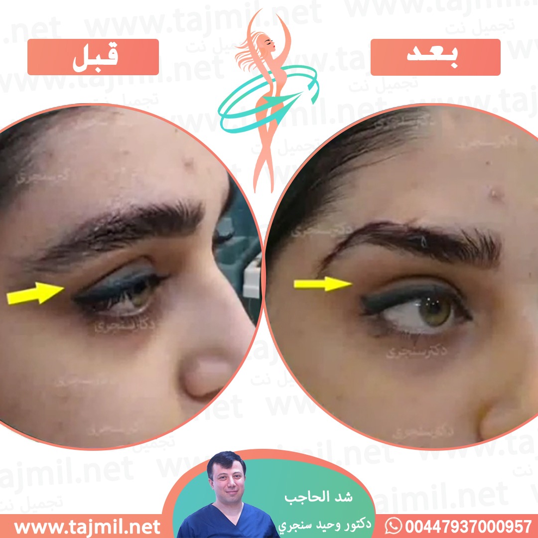  - دکتور وحید سنجري عملية شد الحاجب في ايران مع تجميل نت