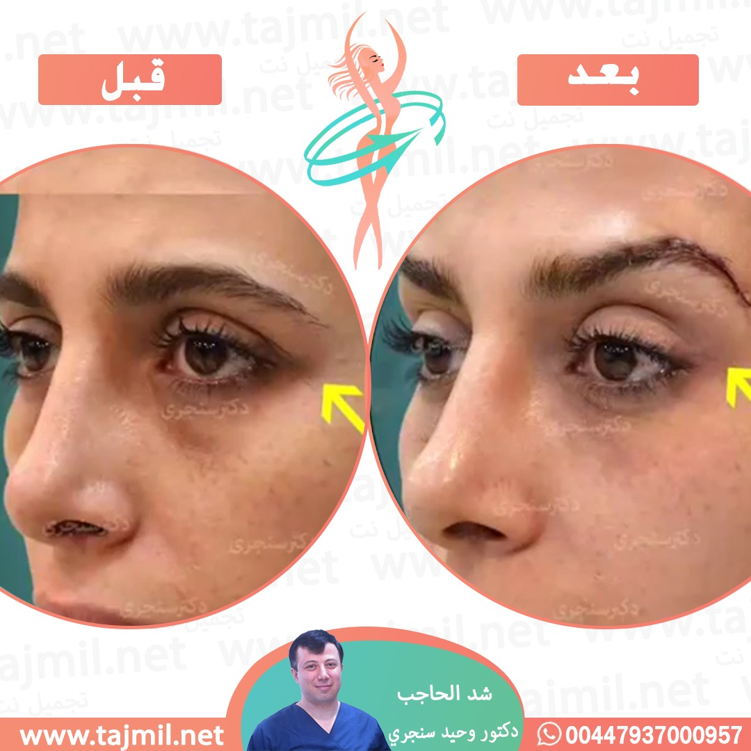  - دکتور وحید سنجري عملية شد الحاجب في ايران مع تجميل نت