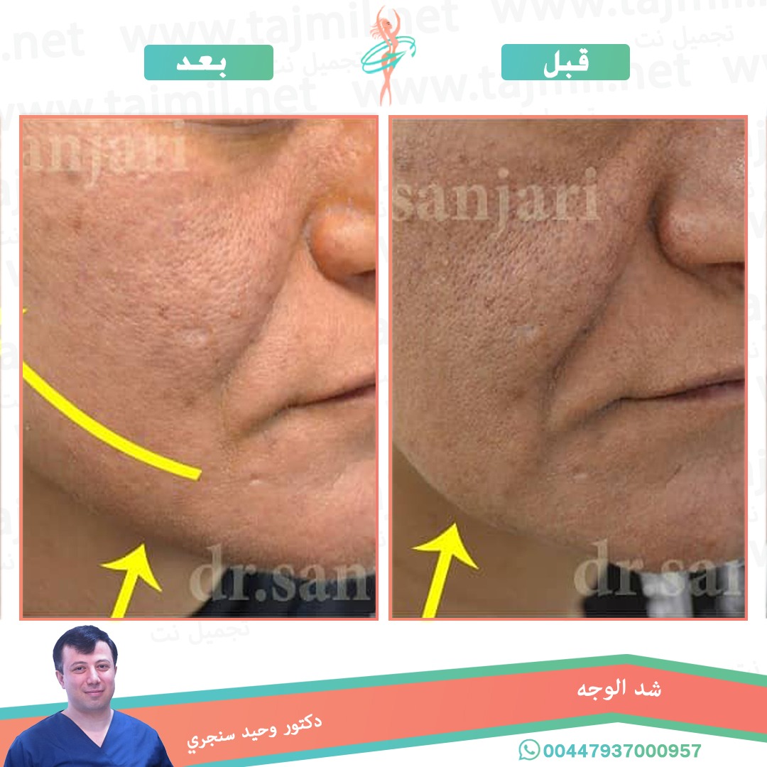  - دکتور وحید سنجري عملية شد الوجه في ايران مع تجميل نت