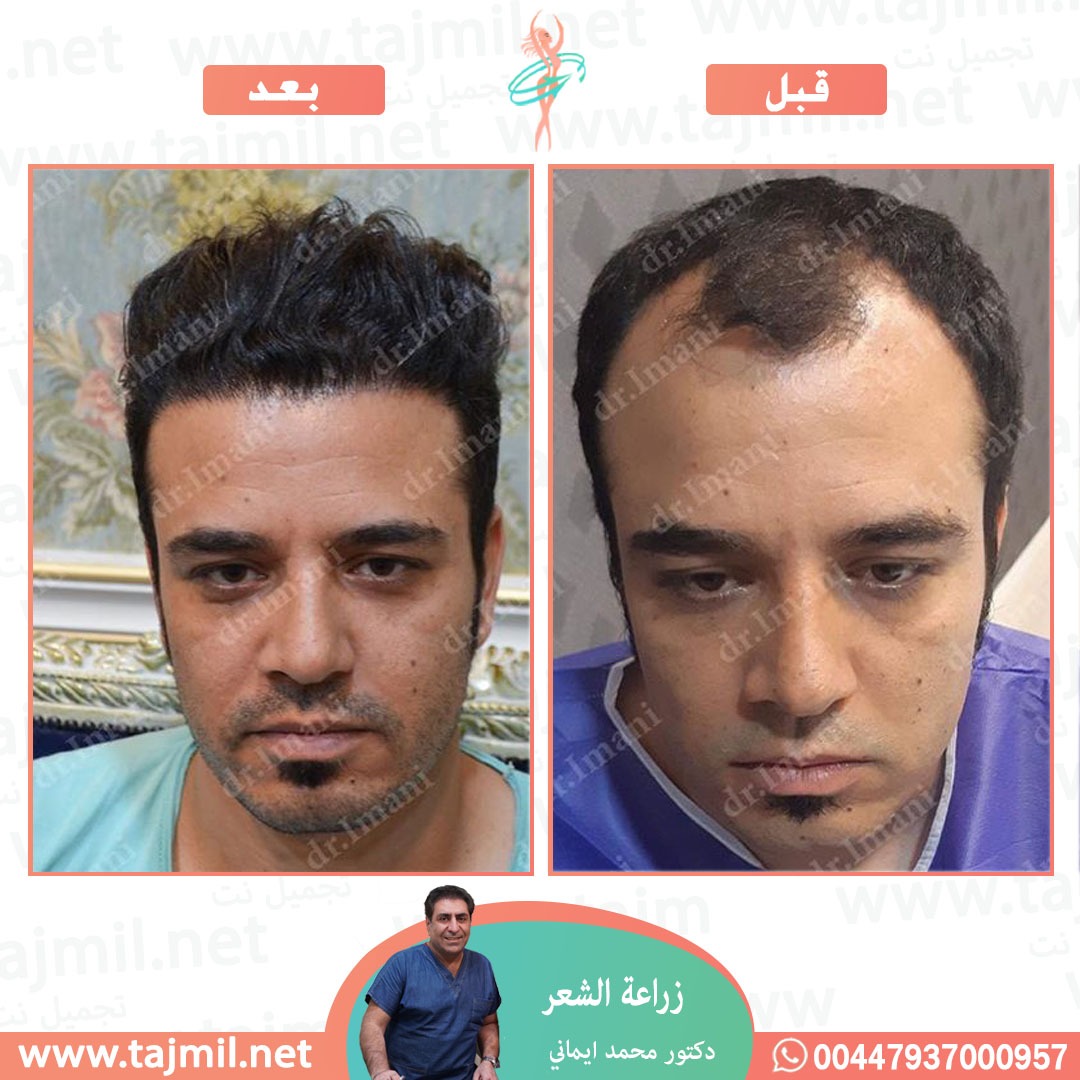  - دکتور محمد ایماني عملية زراعة العشر  في ايران مع تجميل نت