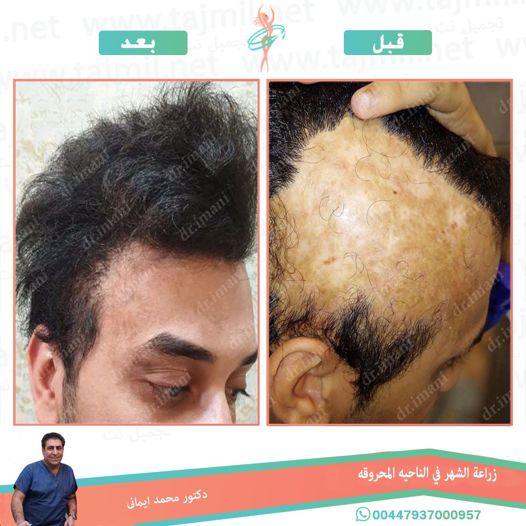  - دکتور محمد ایماني عملية زراعة الشهر في الناحیه المحروقه في ايران مع تجميل نت