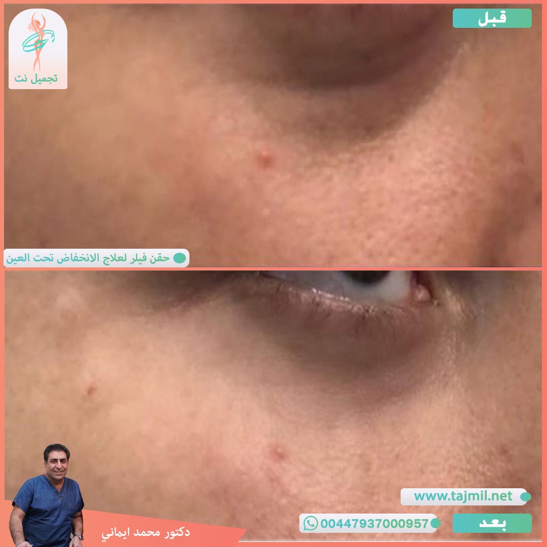  - دکتور محمد ایماني عملية حقن فیلر لعلاج الانخفاض تحت العین  في ايران مع تجميل نت