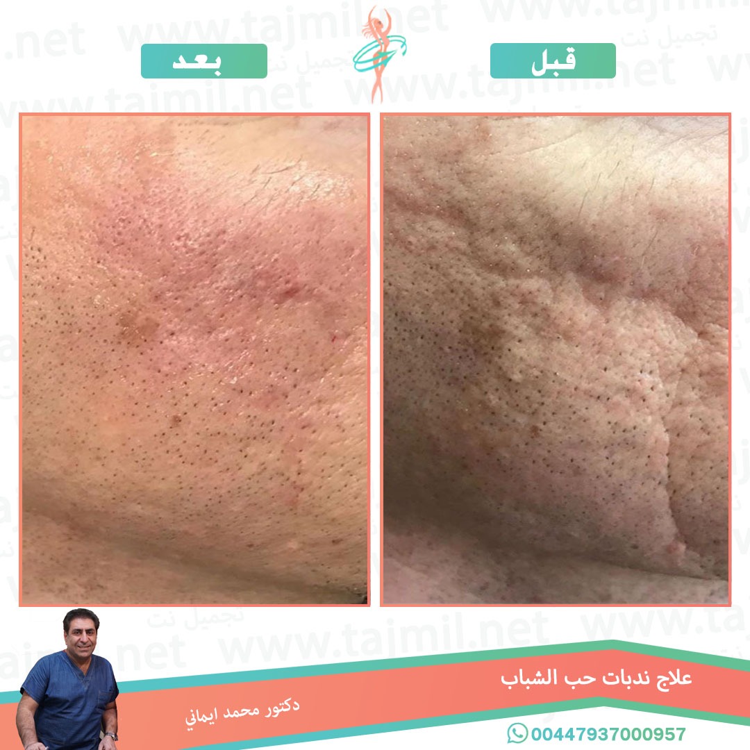  - دکتور محمد ایماني عملية علاج ندبات حب الشباب في ايران مع تجميل نت