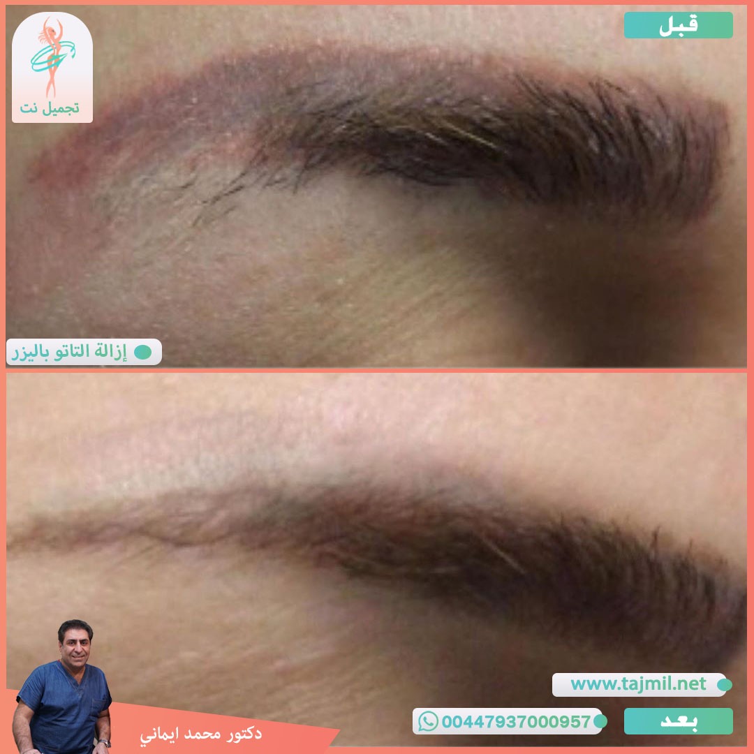  - دکتور محمد ایماني عملية إزالة التاتو بالیزر  في ايران مع تجميل نت