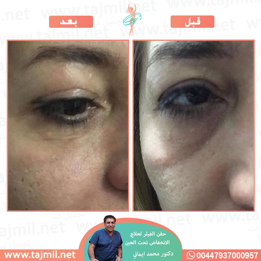  - دکتور محمد ایماني عملية حقن فیلر لعلاج الانخفاض تحت العین  في ايران مع تجميل نت